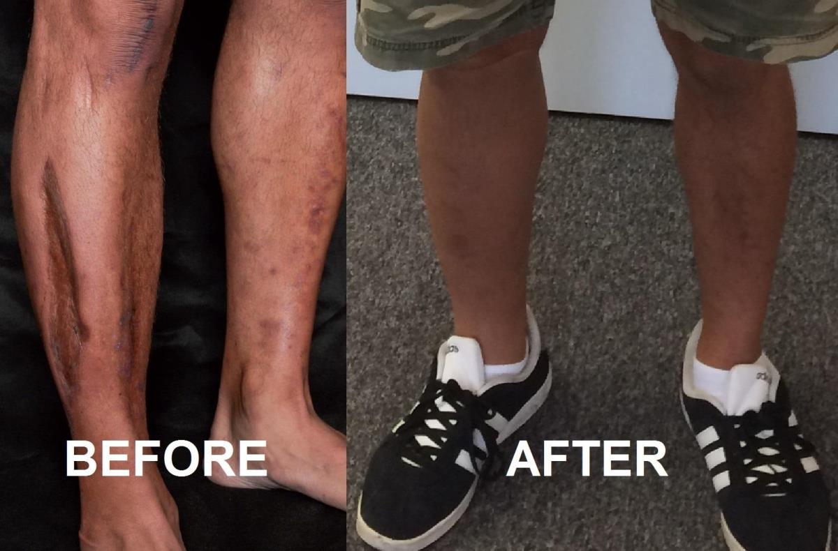 before a scarred leg and after a cosmesis covered up 