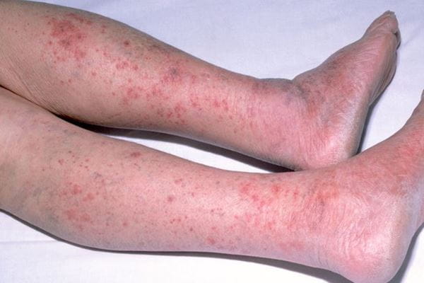 meningitis rash on child's legs