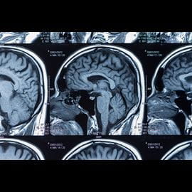 Brain injury treatment involving an MRI scan
